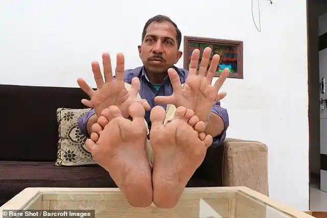 Most Fingers and Toes on a Living Person