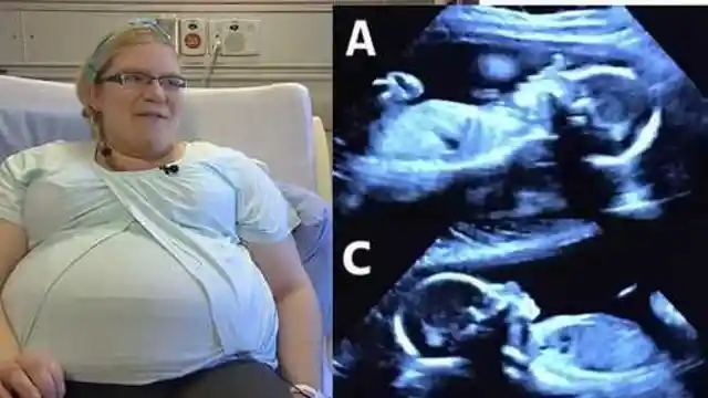 The Doctors Couldn't Believe Their Eyes When They Saw The Pregnant Woman's Scan