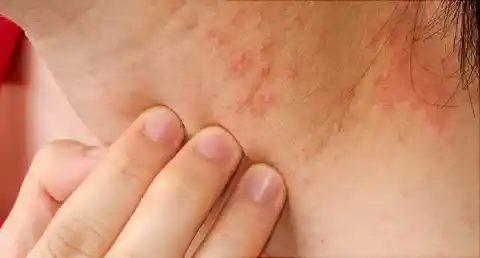 Eczema treatment