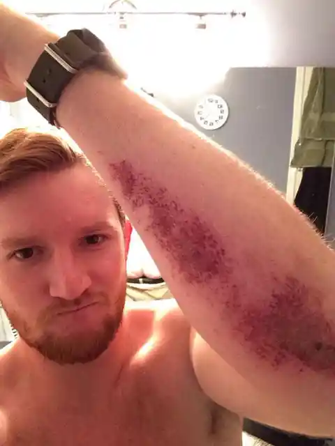 Road Rash Mirror Burn